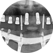 CAD/CAM義齒制作實(shí)現(xiàn)即刻修復(fù)