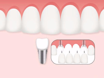 惟德口腔口腔種植怎么樣？惟德口腔就來為您一一解答