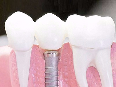 在承德口腔種植齒需要多少錢？惟德口腔一一為您道來(lái)